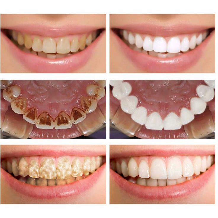 HiSmile V34 Teeth Whitening Serum Purple 30ml